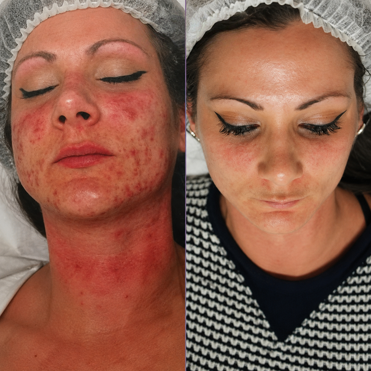 ClearCue acne drying lotion — view 3