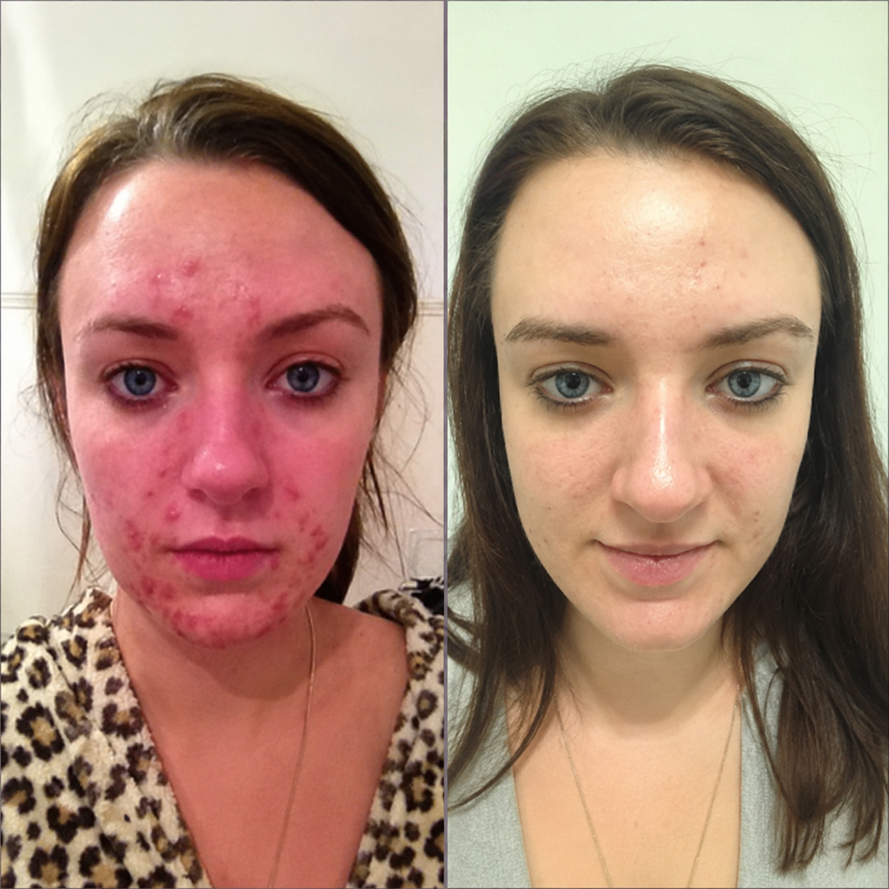 Before and after — clearer skin in 60 days
